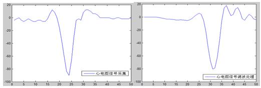 實際心電圖信號的采集與處理效果圖