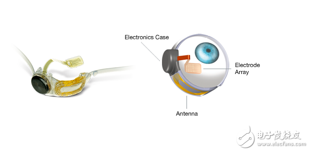 Argus II仿生眼，幫助盲人重見(jiàn)光明!