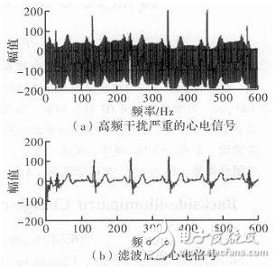 心電信號檢測中濾除肌電干擾的方法解析